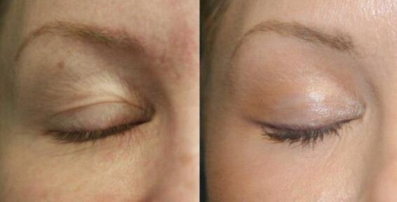 Care for areas near the eyes