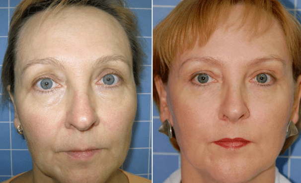 Before and after the renewal procedure
