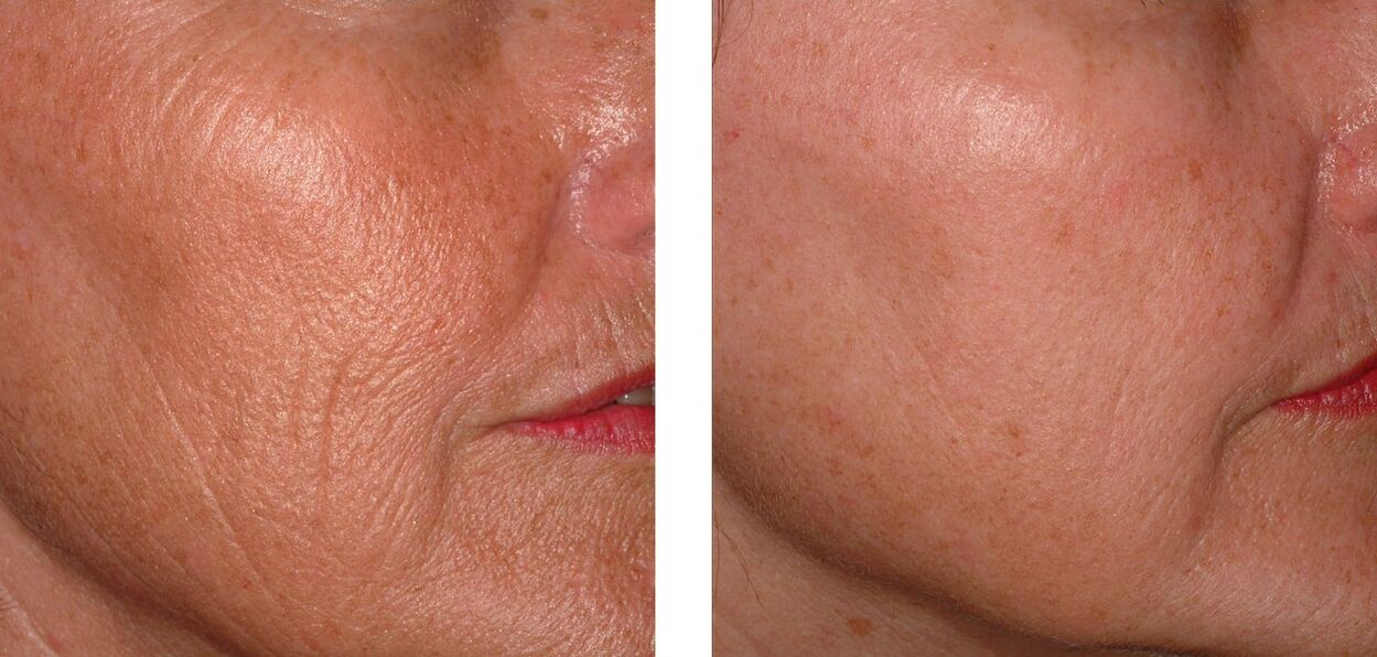 Rejuvenation of the skin