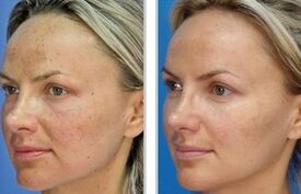 Laser peel