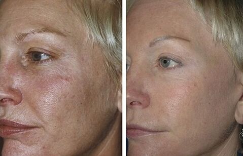 fractional laser resurfacing before and after photos