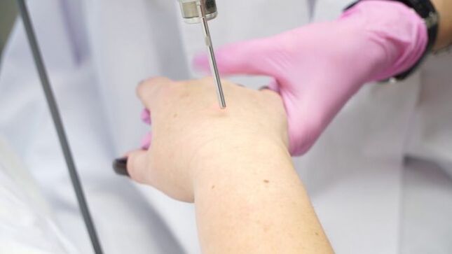 Rejuvenation of the skin of the hands with laser