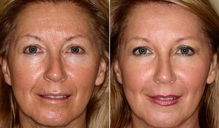 before and after facial skin rejuvenation at home