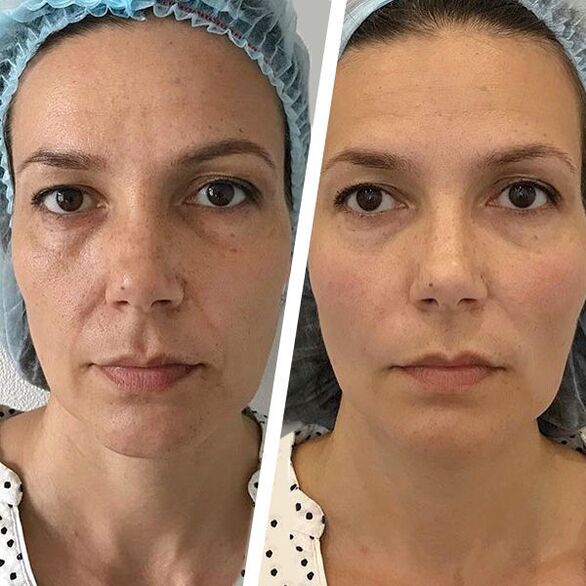 Photo of face before and after laser rejuvenation