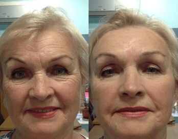 experience using Goji Cream - personal photos before and after